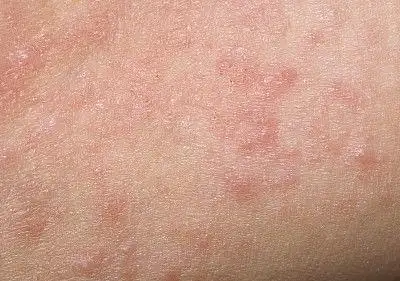 肝脏受到损害时的信号皮肤痒眼发痒肩痛