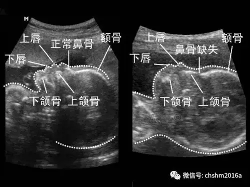 产科超声软指标