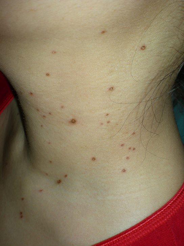 丝状疣的对比图片