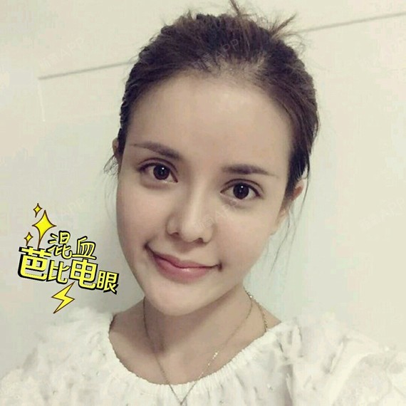 欧式全切双眼皮术后第十天