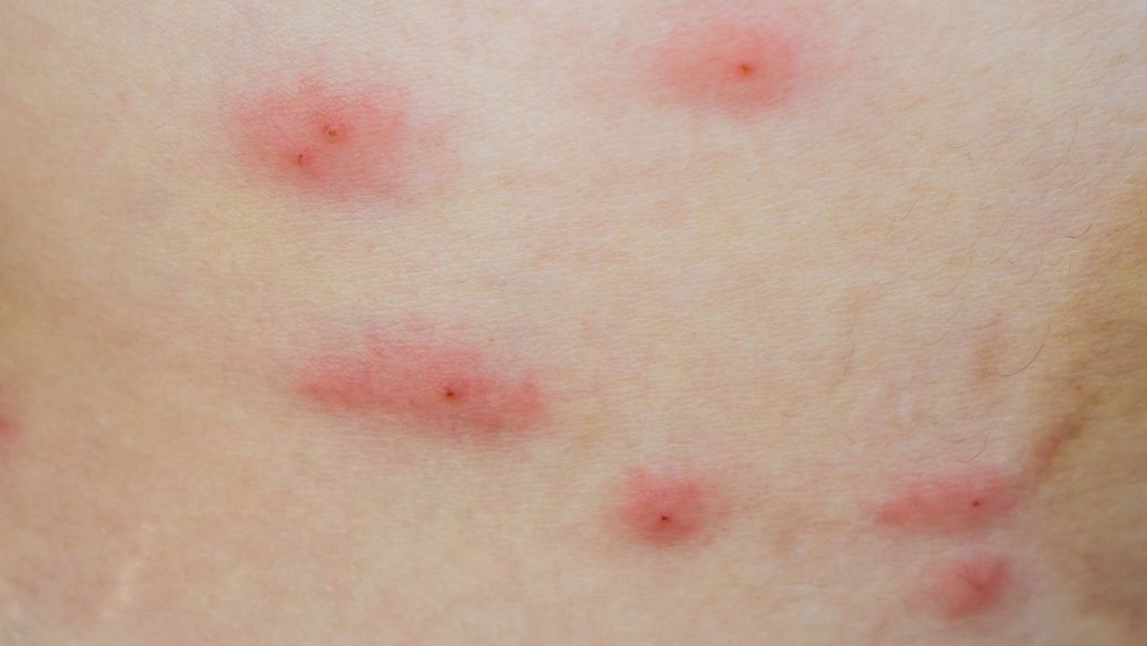 一期梅毒疹图片介绍