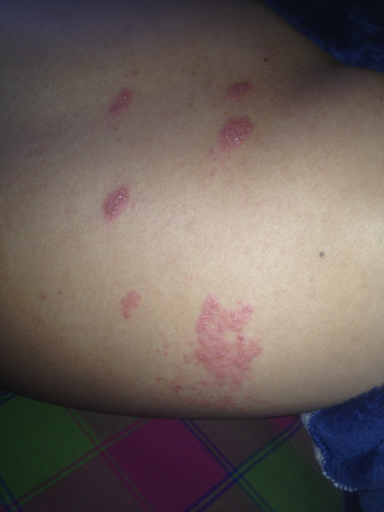 病毒性疱疹是不是可以自愈啊?下面这两张图片是不是疱疹?