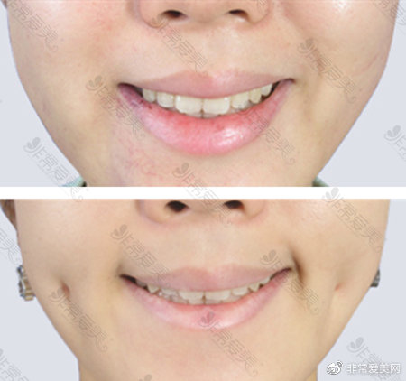 酒窝整形对比案例