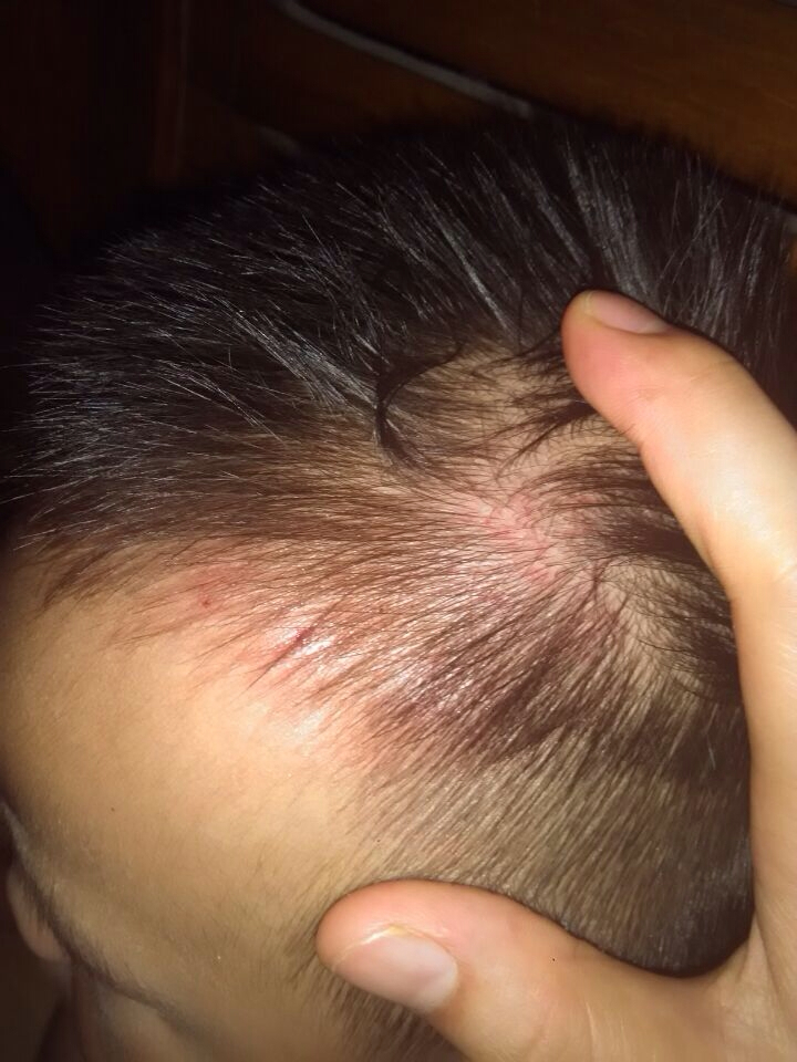 一岁半的小宝宝从一米的高空摔下来,头部这个摔的比较严重,但是不知道