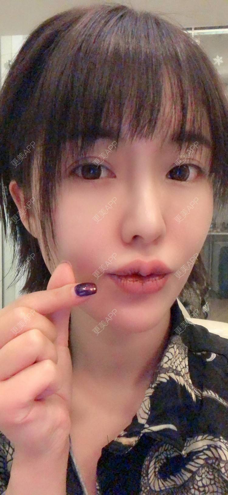 更美用户pd7jekbfig的m唇成形日记