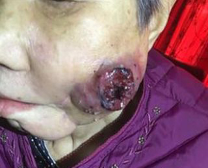 牙龈癌早期症状图片(55)