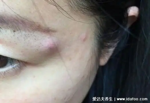 皮脂腺囊肿粉瘤图片及症状,感染后红肿疼痛严重影响美观