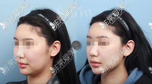 韩国snow整形面部吸脂手术前后对比案例分享
