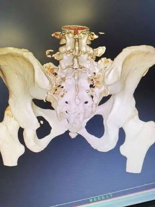 一例骶骨粉碎性骨折的治疗