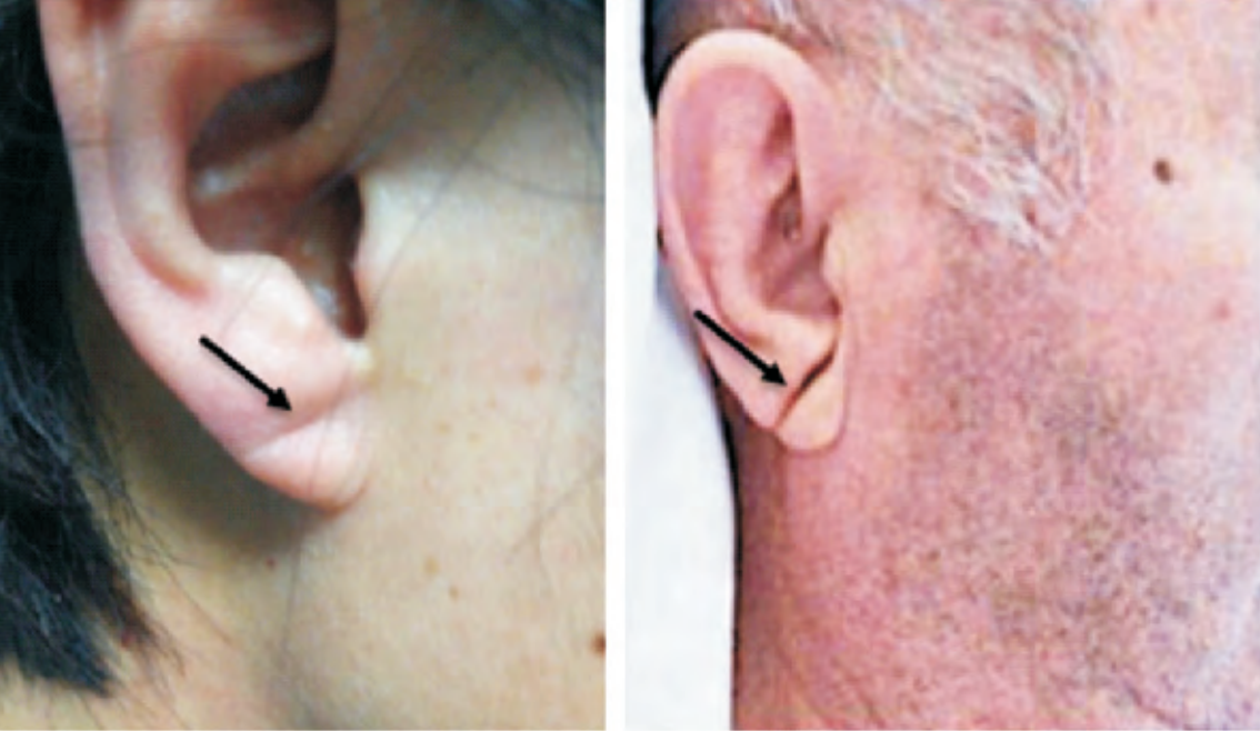 耳垂有折痕是心梗的标志?辟谣:可以警惕风险,但不应划等号