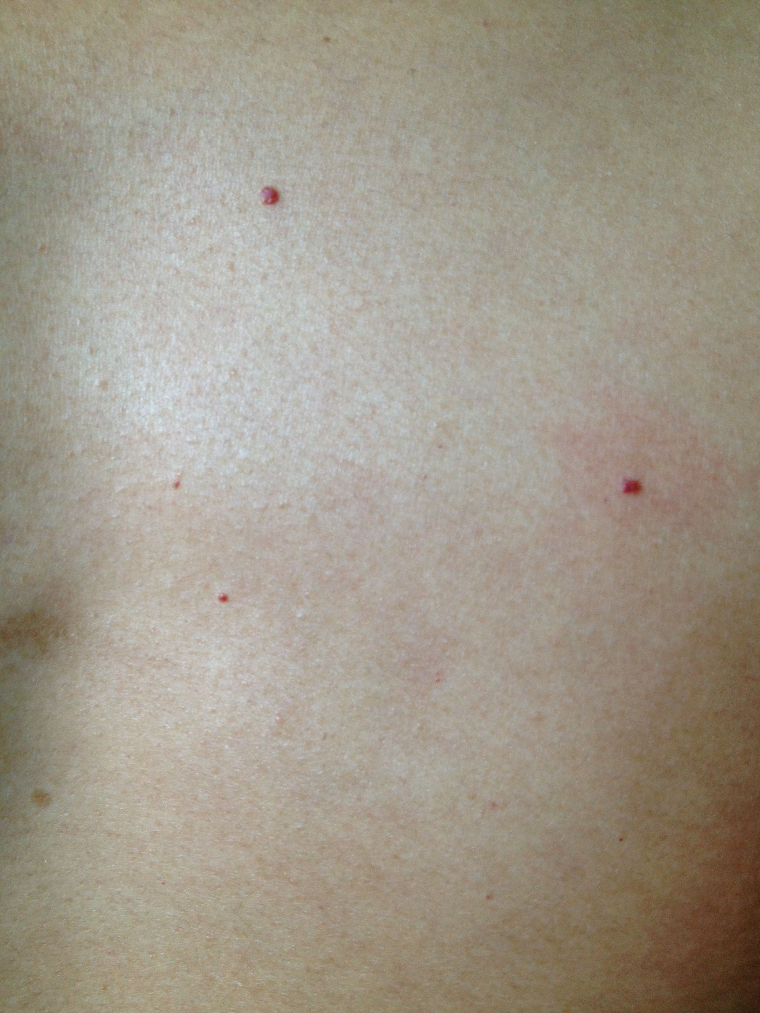 问:身上有红点,不疼不痒.