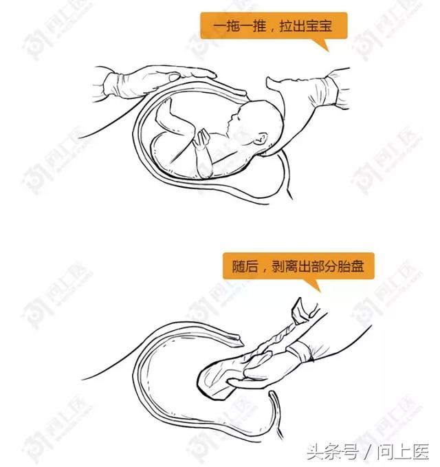 哪7种情况必须剖腹产?横切or竖切?医学漫画为你揭秘!