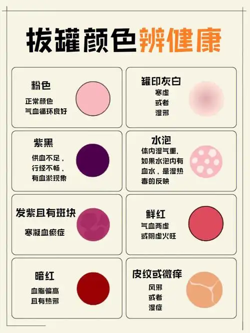 养生攻略73拔罐颜色辨健康