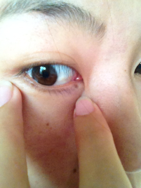 右眼感觉模糊 不严重 眼白处有白色水泡 眼角感觉多一层肉 我不知道