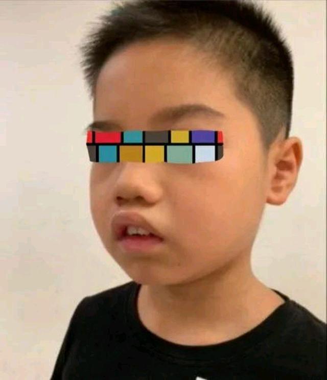 "腺样体面容"怎么预防和处理?