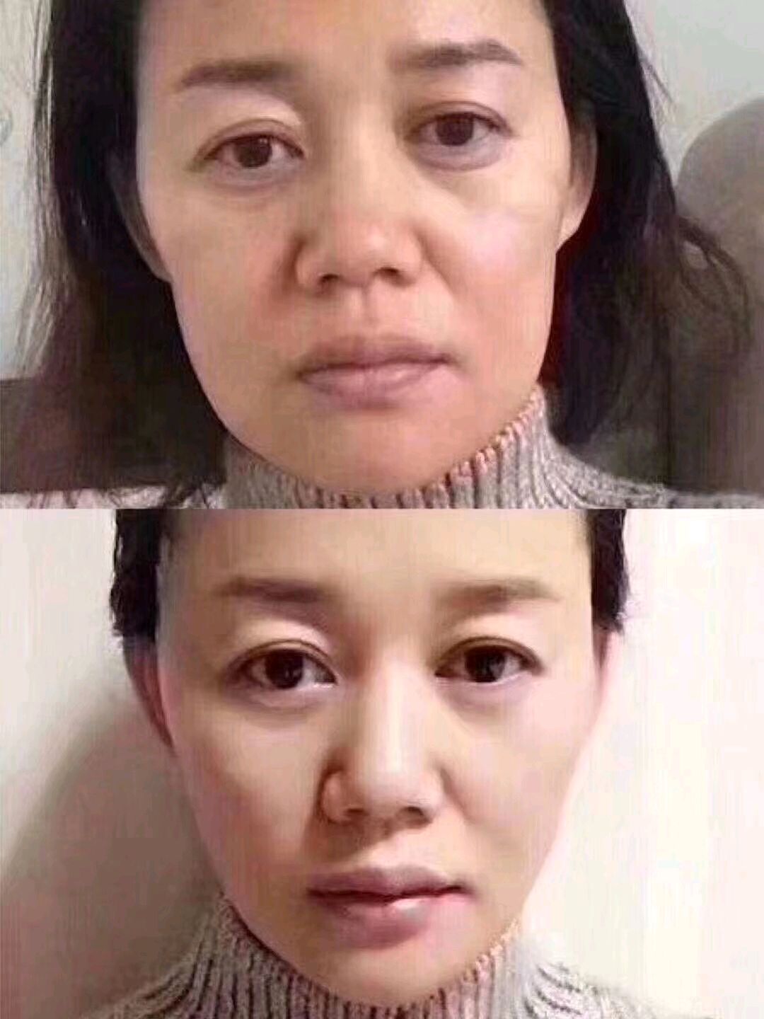 适用于线雕大v线的情况有哪些