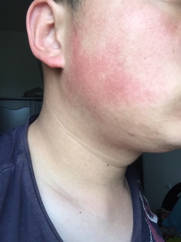 我的脸一直是红的,怎么回事,能治吗?