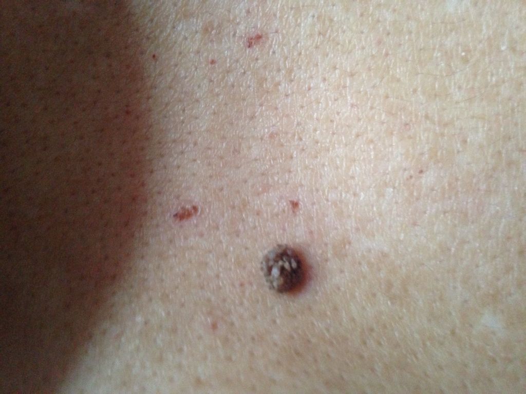 后背脊骨地方长了一个肉阄,就像花一样有很多很多的小花瓣,请问专家这