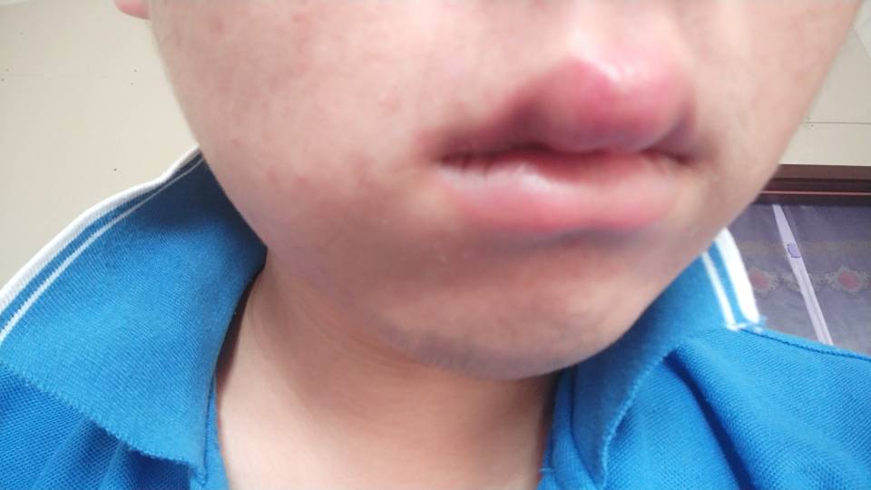 上嘴唇中间肿了,这是第二天,昨天没这么大