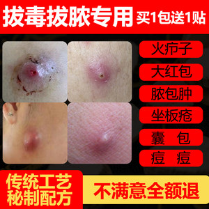 火疖子拔毒膏贴图片