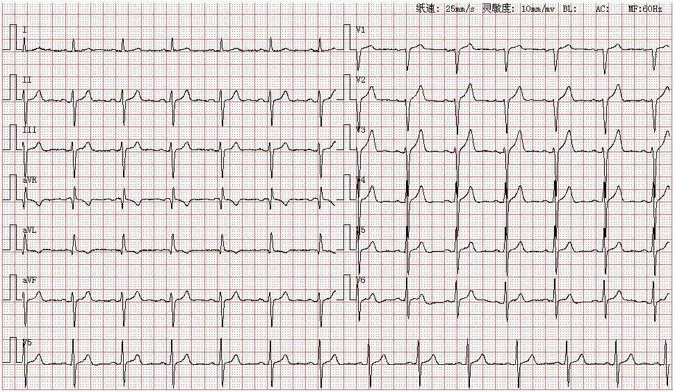 心电图图库丨左前分支阻滞系列