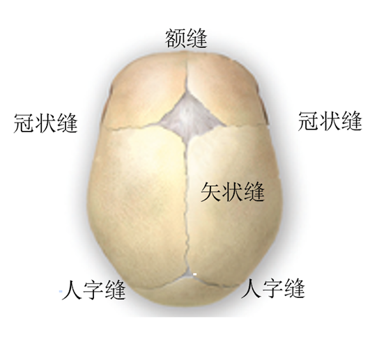 简单颅缝早闭示意图:1)额缝早闭2)双侧冠状缝早闭3)单侧冠状缝早闭4)
