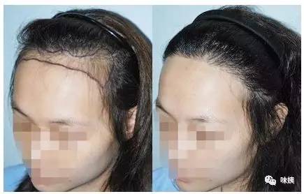 优点在于 一劳永逸,不用再担心画出来的发际线太假,或者容易脱妆,不敢