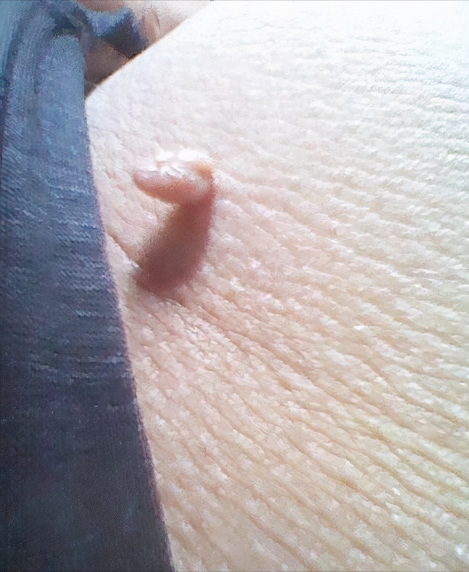 腋下长了个小肉粒图片(脖子上长了) - 赤虎壹号