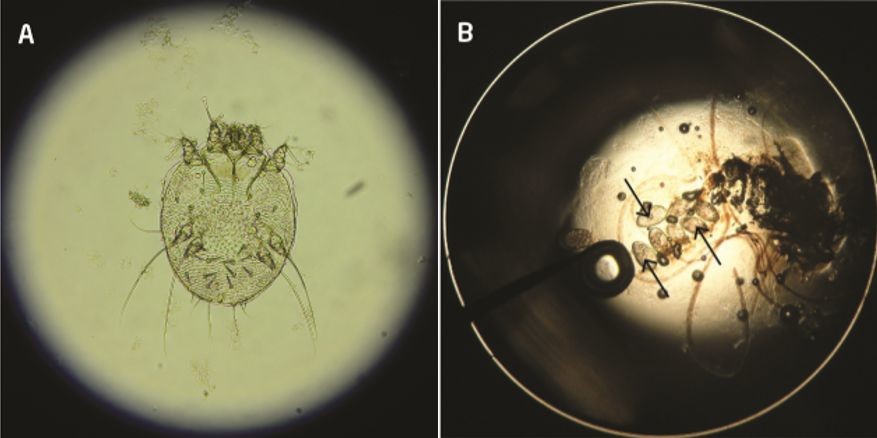 图3. 皮肤取材在光学显微镜下诊断疥疮,a.雌性疥螨,放大200倍;b.