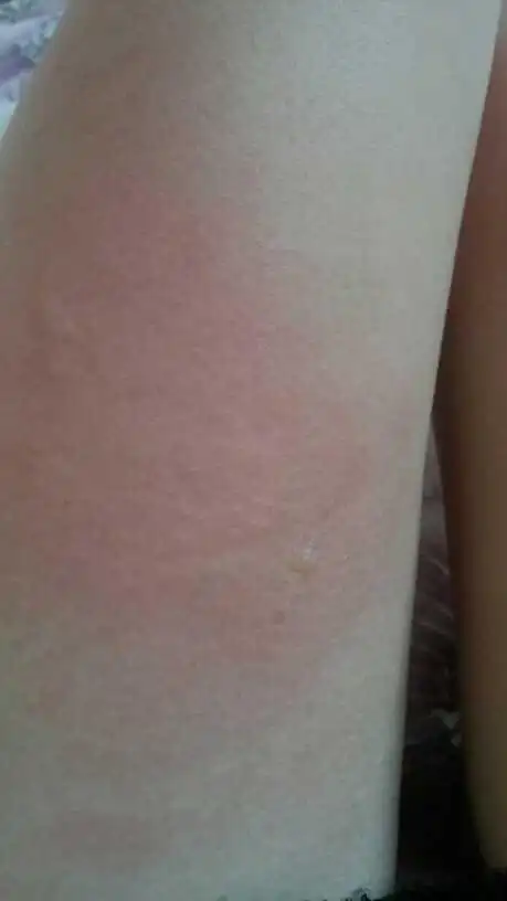 腿被开水烫了,痛死了