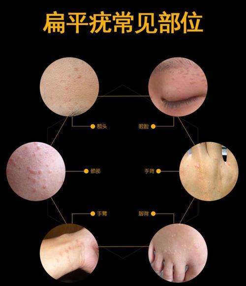 第一次长扁平疣武汉太医堂中医院一分钟带你了解扁平疣及解决方法