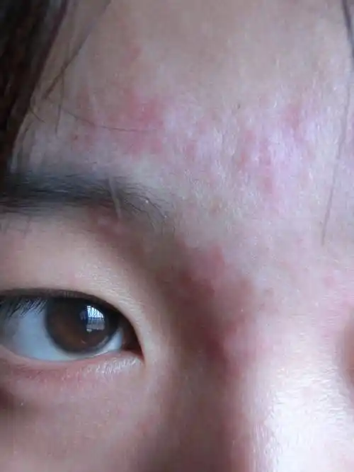 脸敷面膜过敏症状图片 敷面膜过敏是什么症状图片