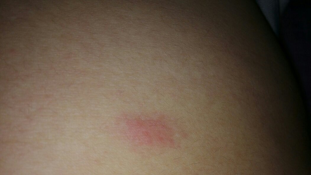 身上莫名其妙长了几个红疙瘩,很痒