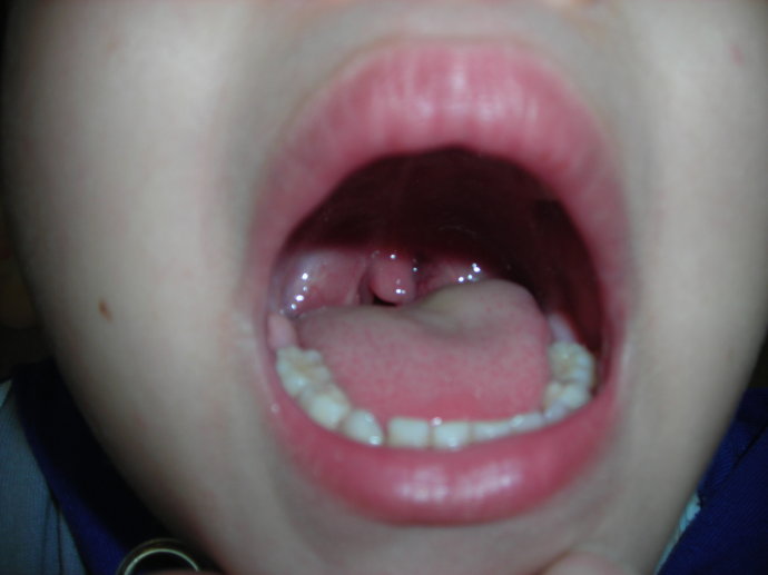 扁桃体肿大图片50