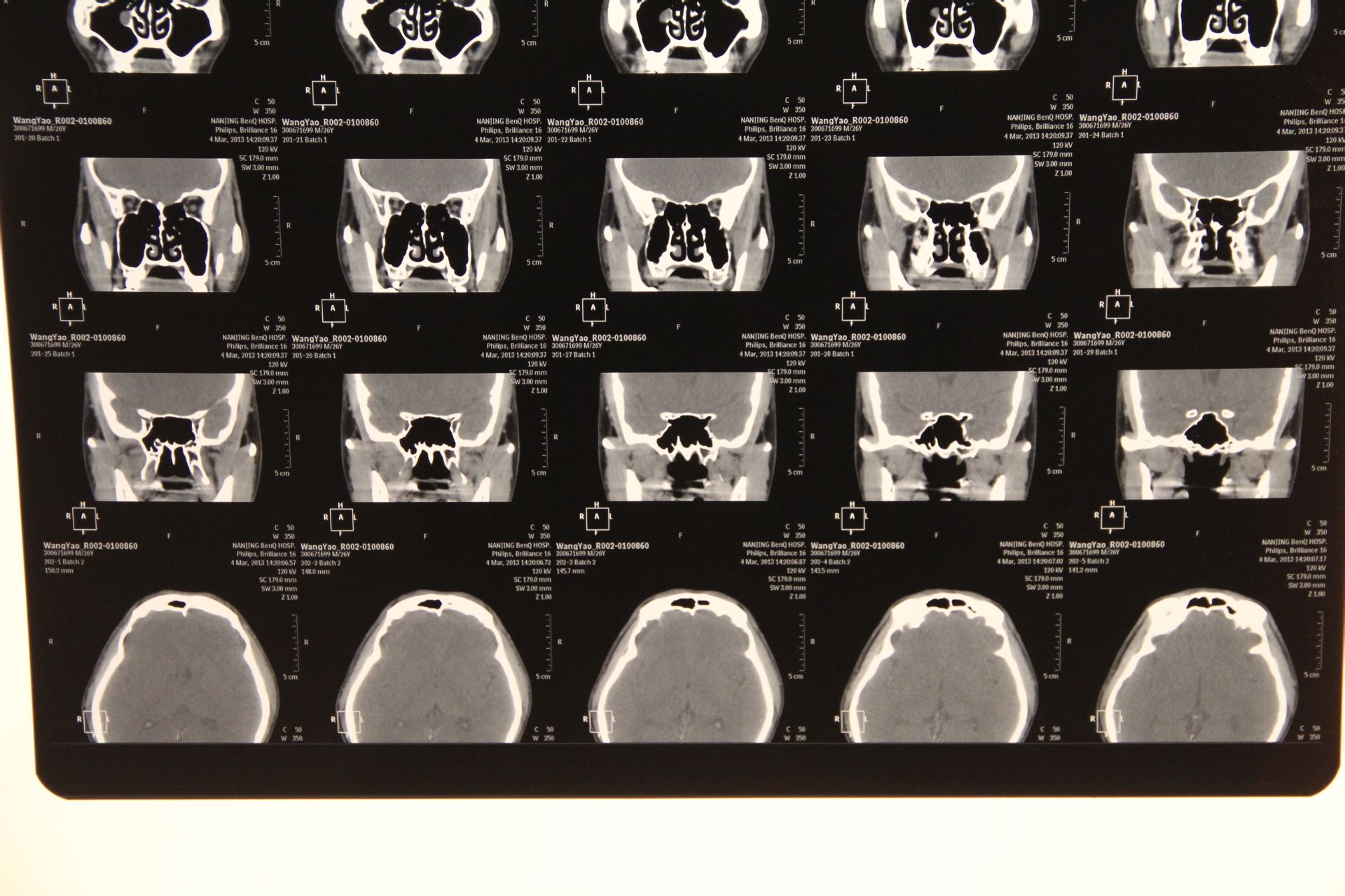 帮我看下这个ct图片,上颌窦里面有东西.现在鼻子很不舒服.