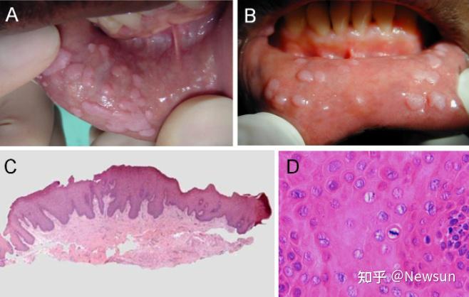 口腔hpv感染都有哪些症状?(附图片)