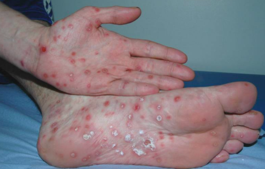 梅毒图谱及病例展示【图片内容可能使您感到不适请谨慎点击】 .