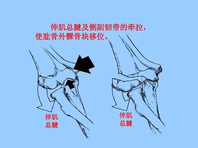 伸肌总腱及侧副韧带的牵拉, 使肱骨外髁骨块移位.