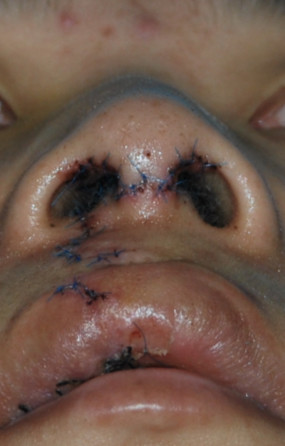 唇腭裂随访唇裂二期修复手术术后1年2月2013年7月手术