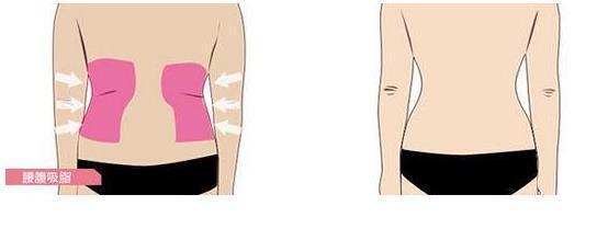陈伟科普篇:腰腹环吸的原理