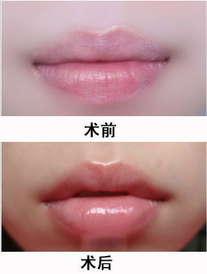 丰唇效果图明显吗_注射丰唇_整形频道_寻医问药网