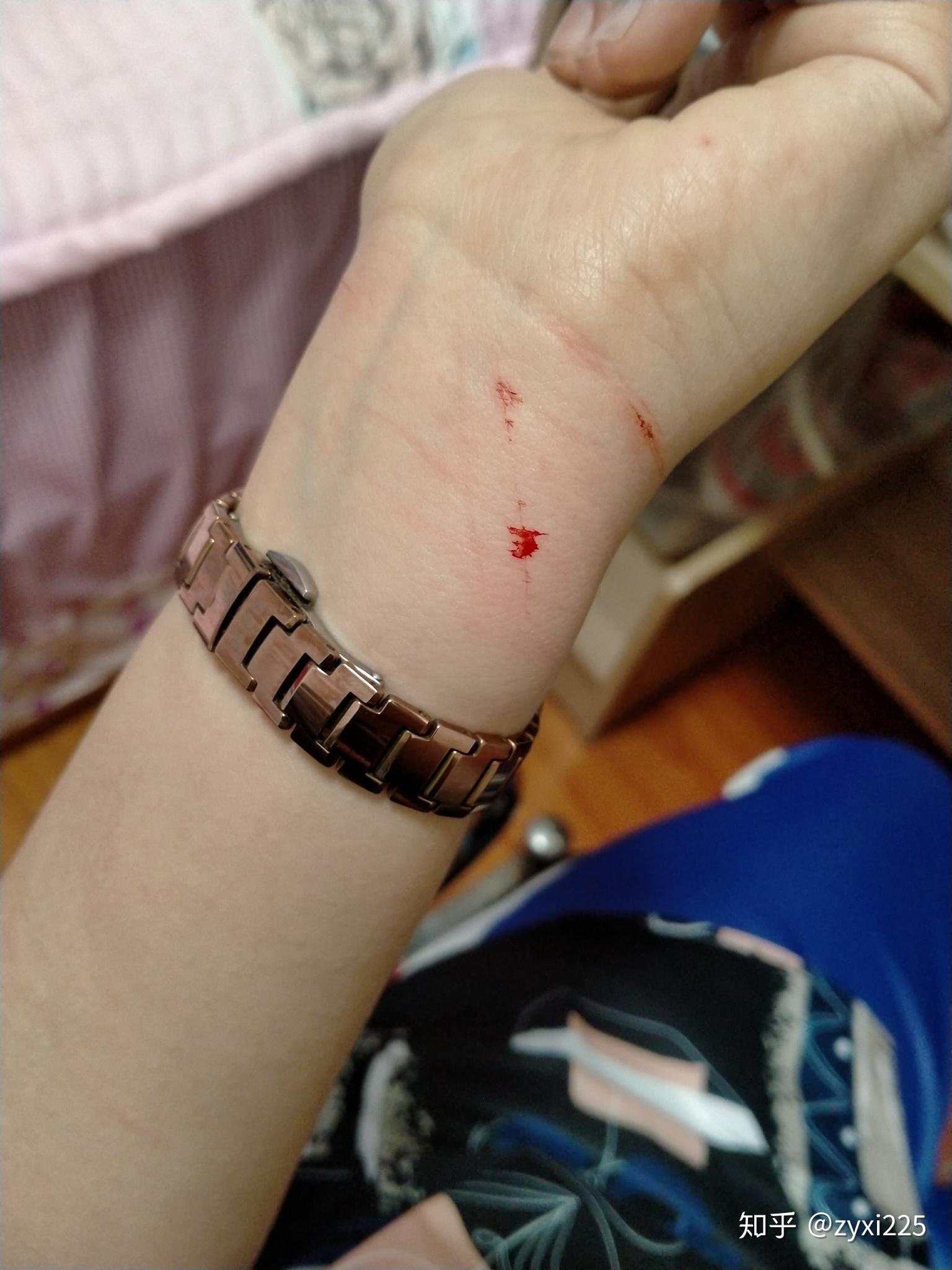 怎样拯救一个自残过的女生