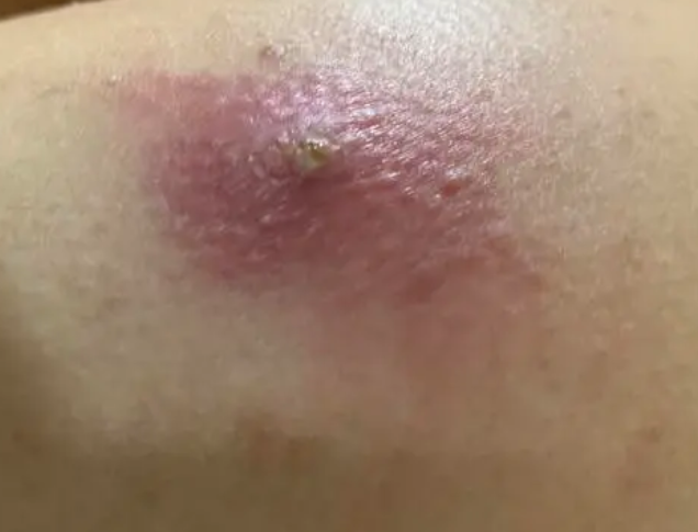 我婆婆今年60岁,后背长了个大疙瘩,我觉得像是脂肪瘤,但是婆婆说不疼