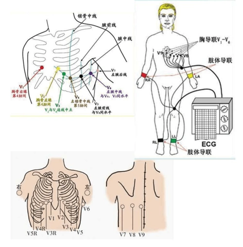 如何连接心电图十二十八导联