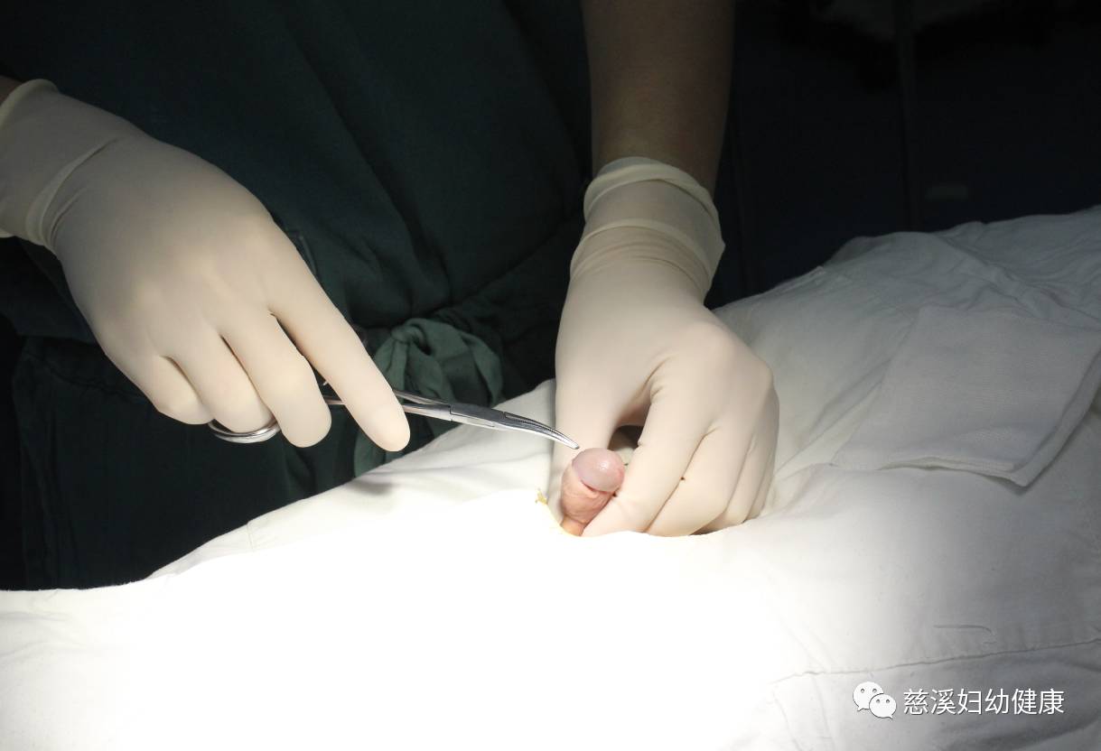 关注暑期迎来小儿包皮手术高峰哪些小朋友需要修理小jj