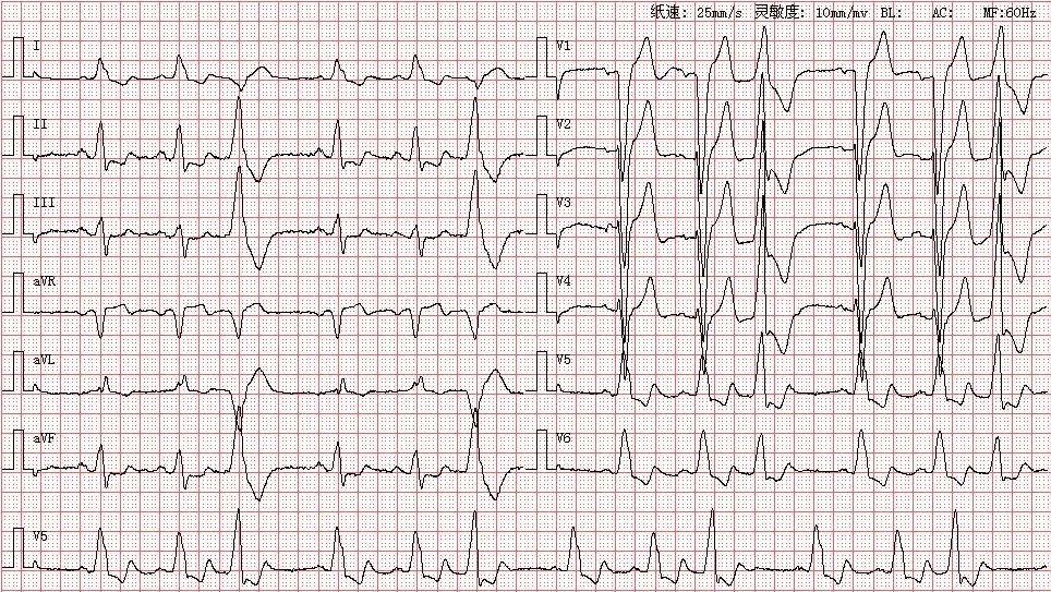 心电图图库丨完全性左束支阻滞系列