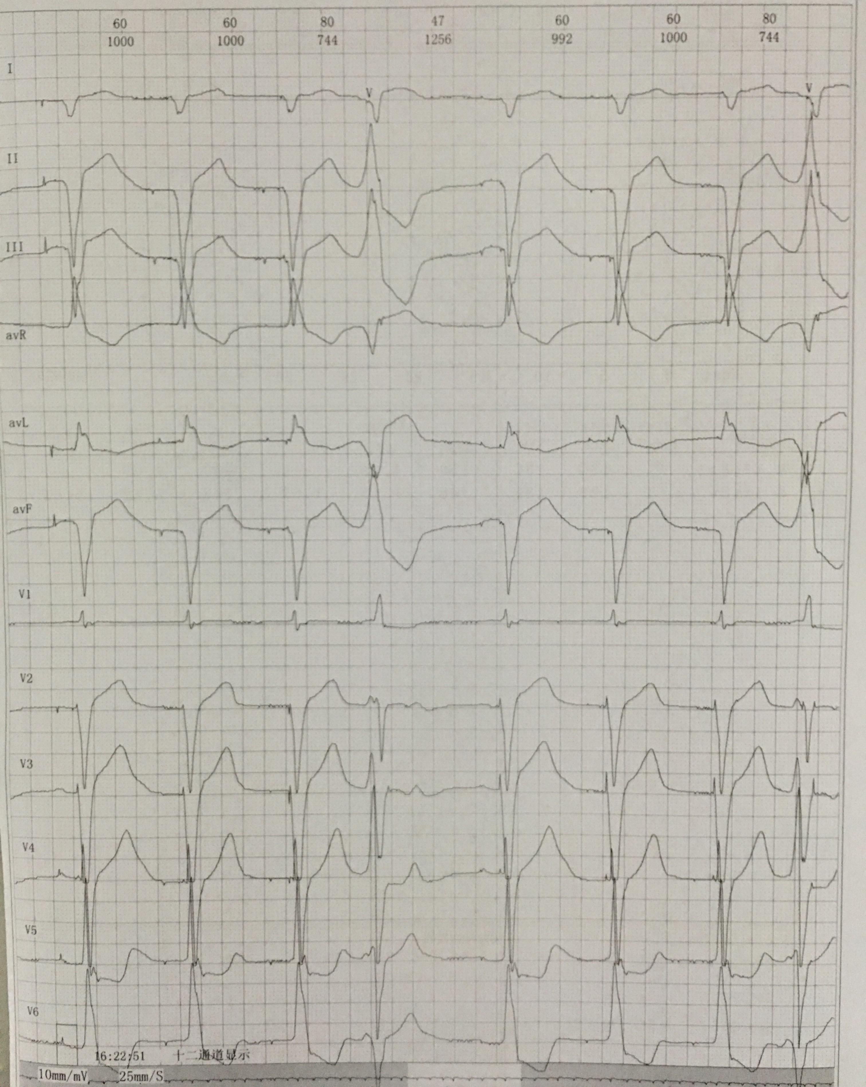三度房室传导阻滞 起搏器心电图