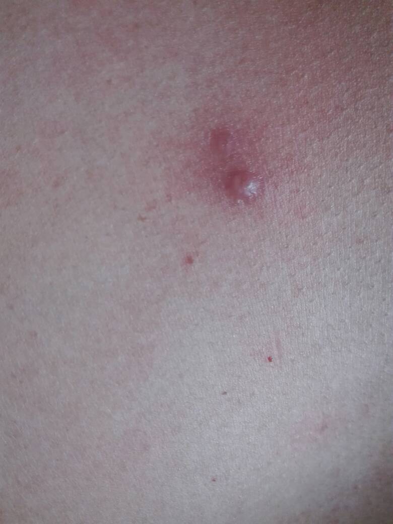 胸部起这个怎么回事,而且身上会痒,是艾滋病嘛,虽然有过高危行为,但是