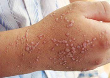 扁平疣用大蒜偏方