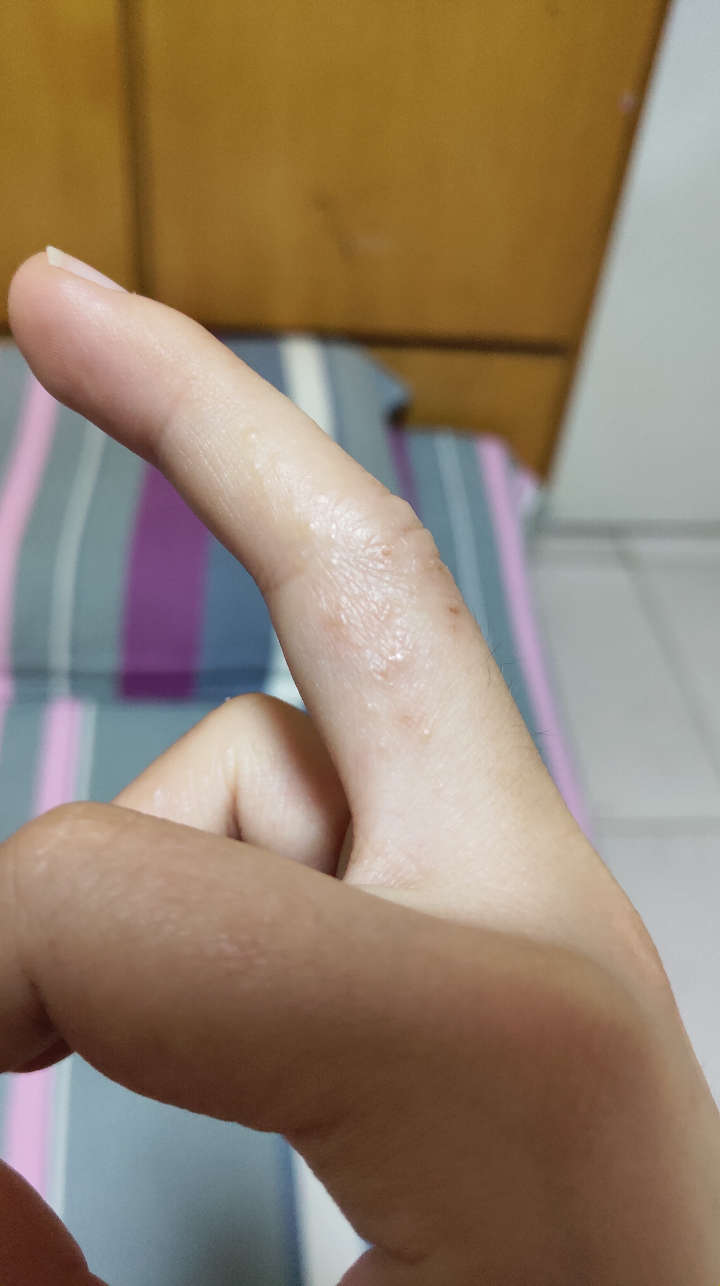 手上起一片一片的小水泡很痒破了流脓发肿手背和指缝多